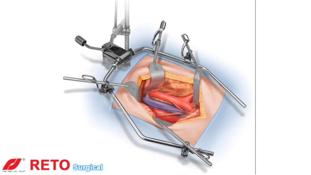 Retractors in Surgery